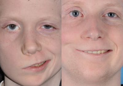 Gracilis Before & After Gallery - Patient 363435 - Image 1