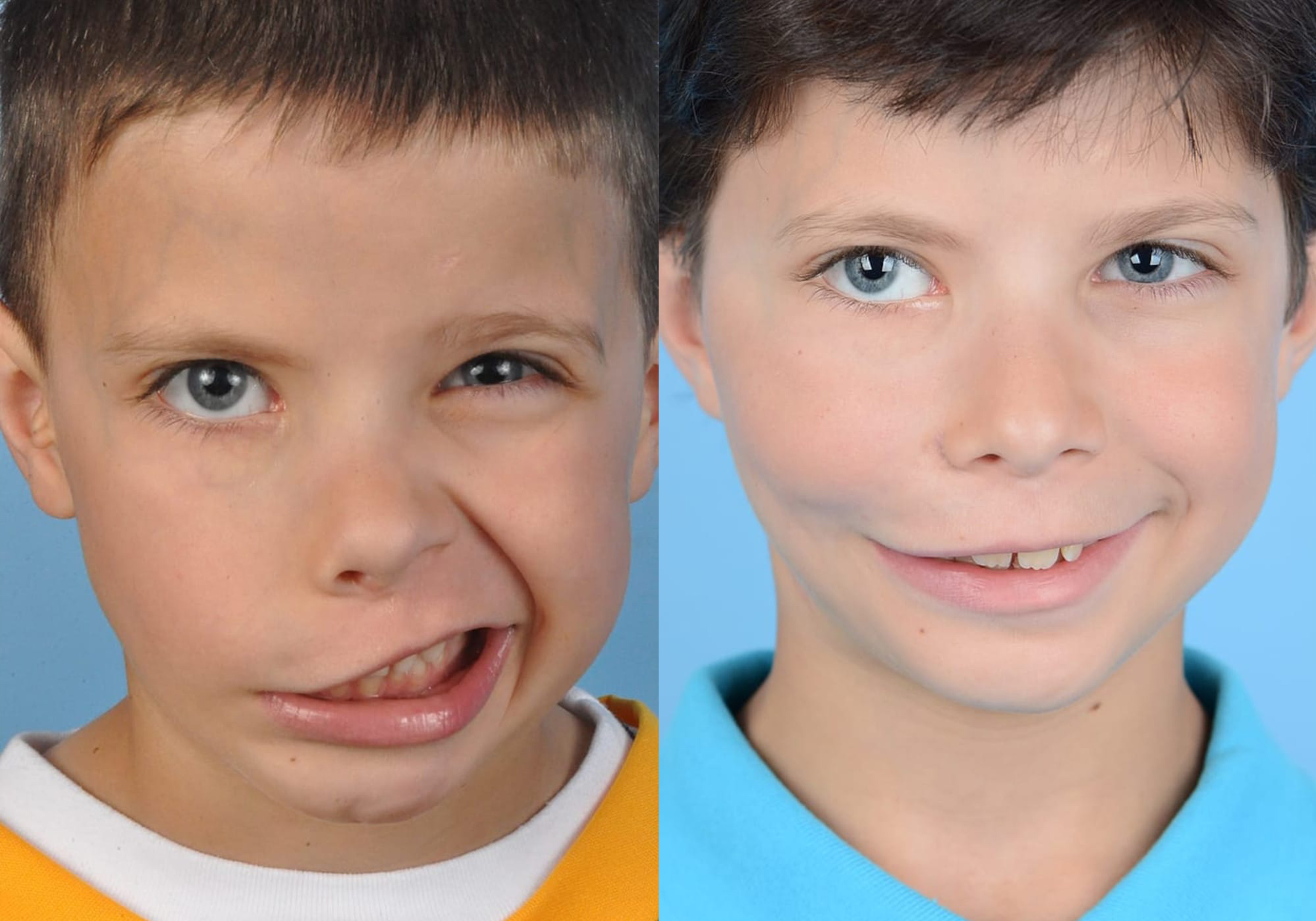 Gracilis Before & After Gallery - Patient 281515 - Image 1