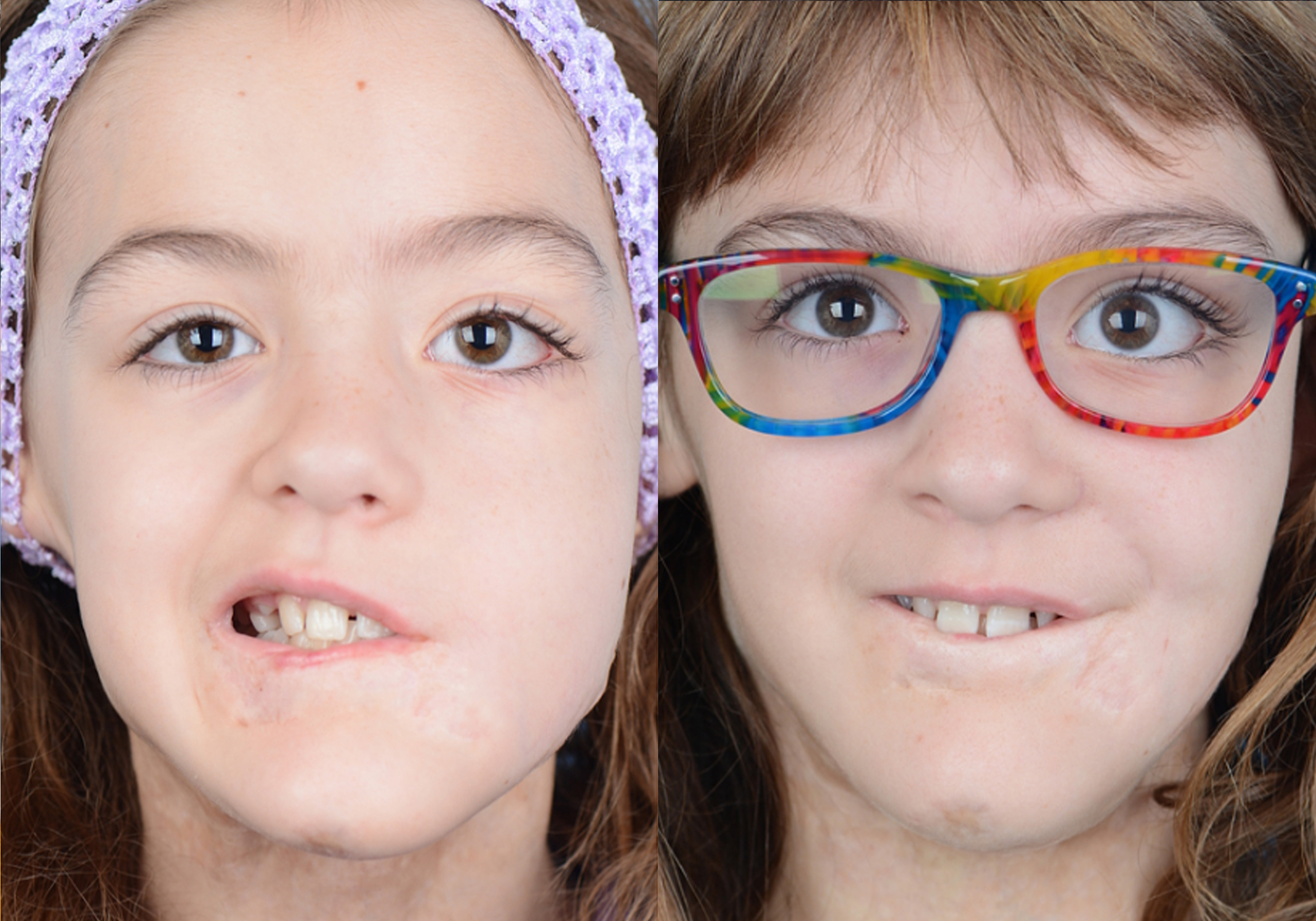 Gracilis Before & After Gallery - Patient 339171 - Image 1