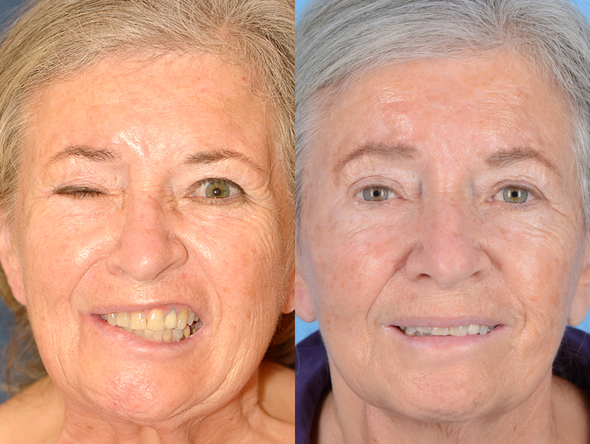 Muscle Resection: DAO, DLI, Ocular Myomectomy, Mentalis Before & After Gallery - Patient 151505 - Image 1