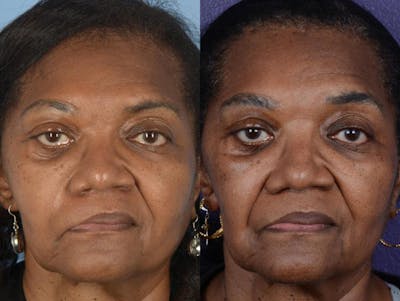 Static Suspension  Before & After Gallery - Patient 539230 - Image 1