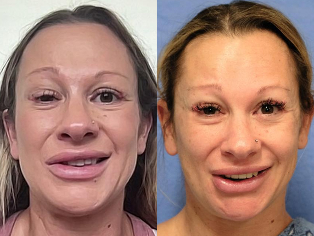 Muscle Resection: DAO, DLI, Ocular Myomectomy, Mentalis Before & After Gallery - Patient 347661 - Image 1