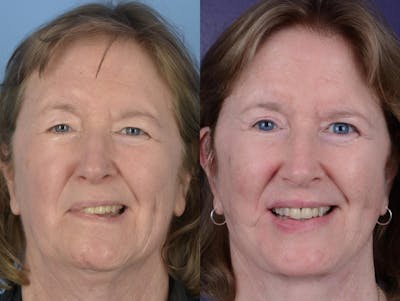 Denervation Before & After Gallery - Patient 104596 - Image 1