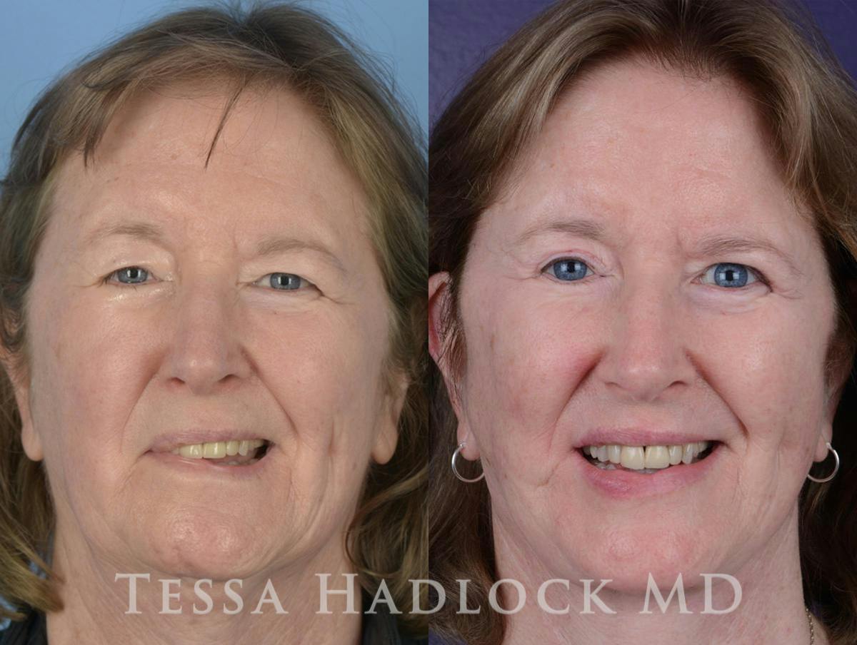 Denervation Skin Patient 104596 | Denervation Before & After Photos | Hadlock Facial ...