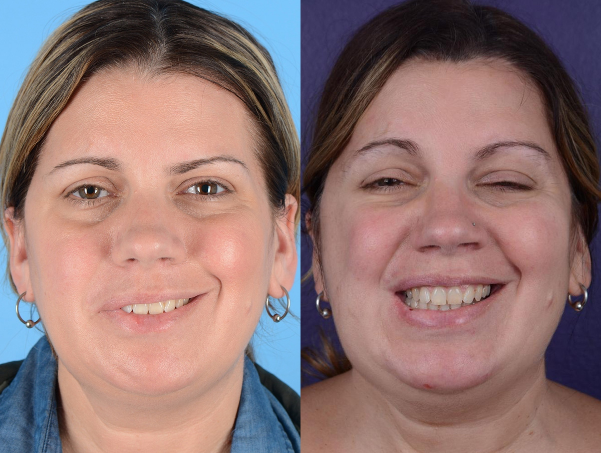 Gracilis Before & After Gallery - Patient 106161 - Image 1