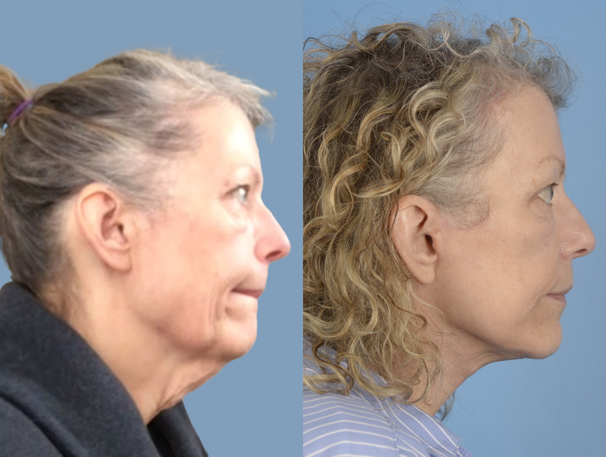 Office Facelift Before & After Gallery - Patient 214053 - Image 1