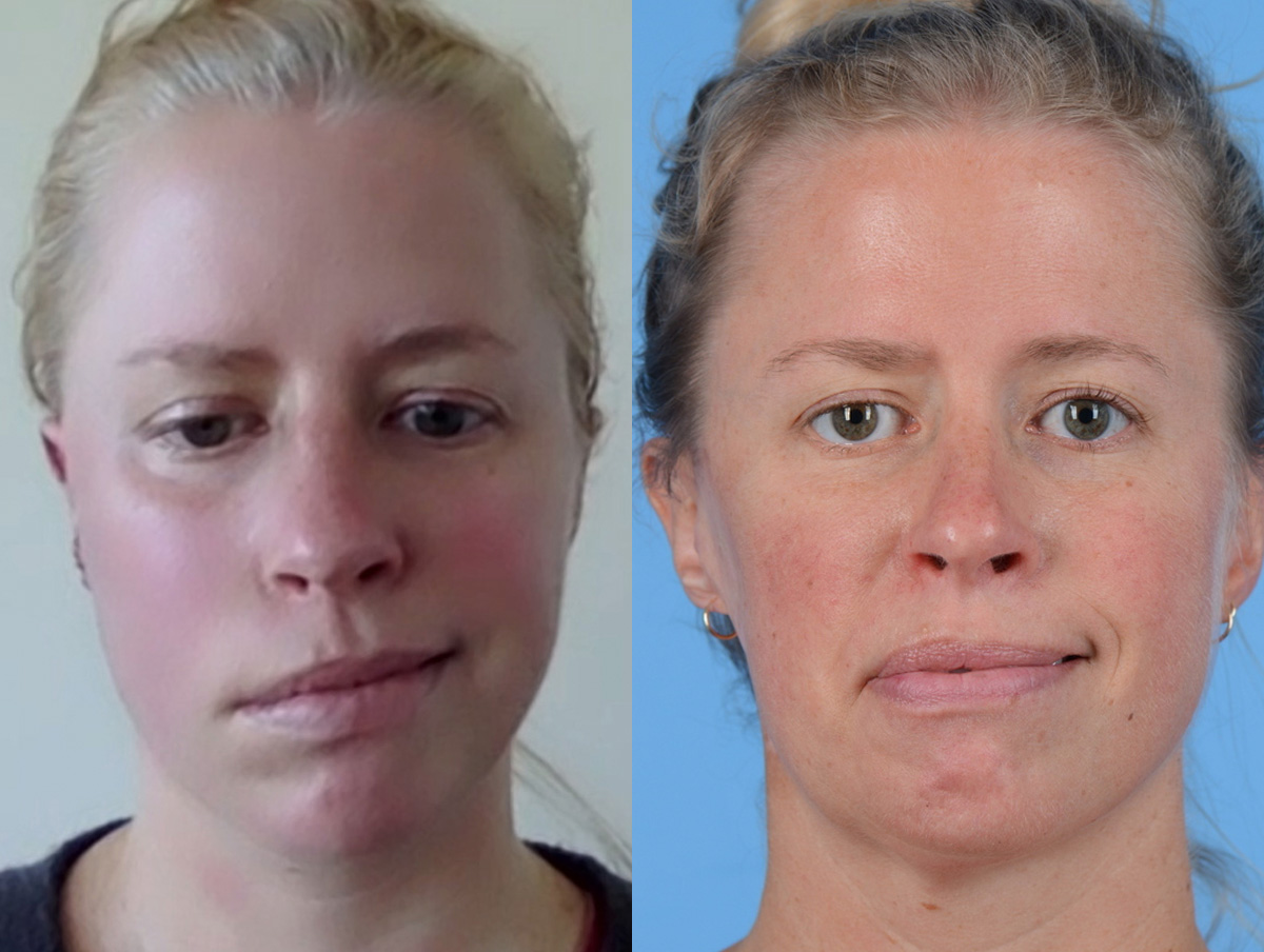 Static Suspension  Before & After Gallery - Patient 231720 - Image 1