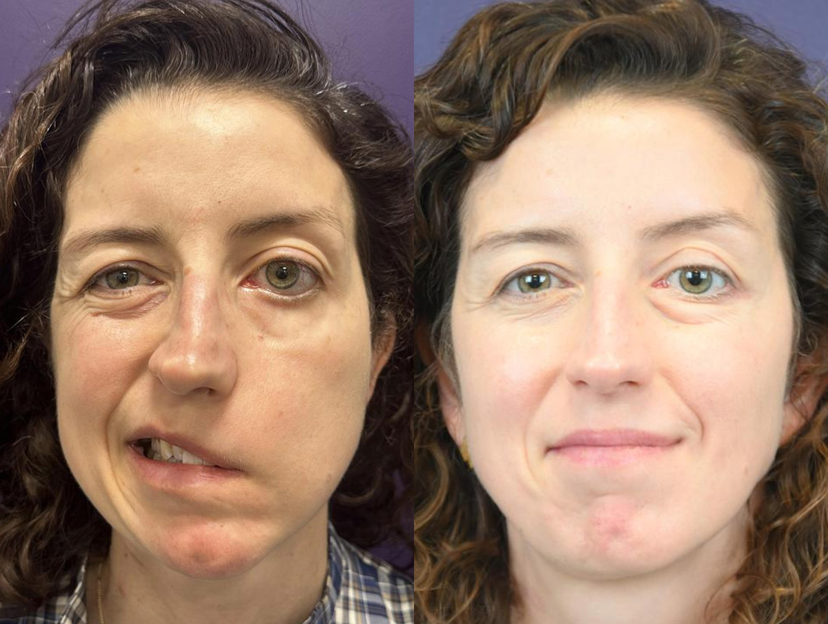 Reinnervation/Nerve Transfers Before & After Gallery - Patient 113753 - Image 1