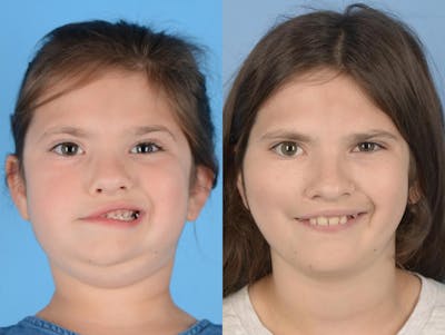 Gracilis Before & After Gallery - Patient 128516 - Image 1