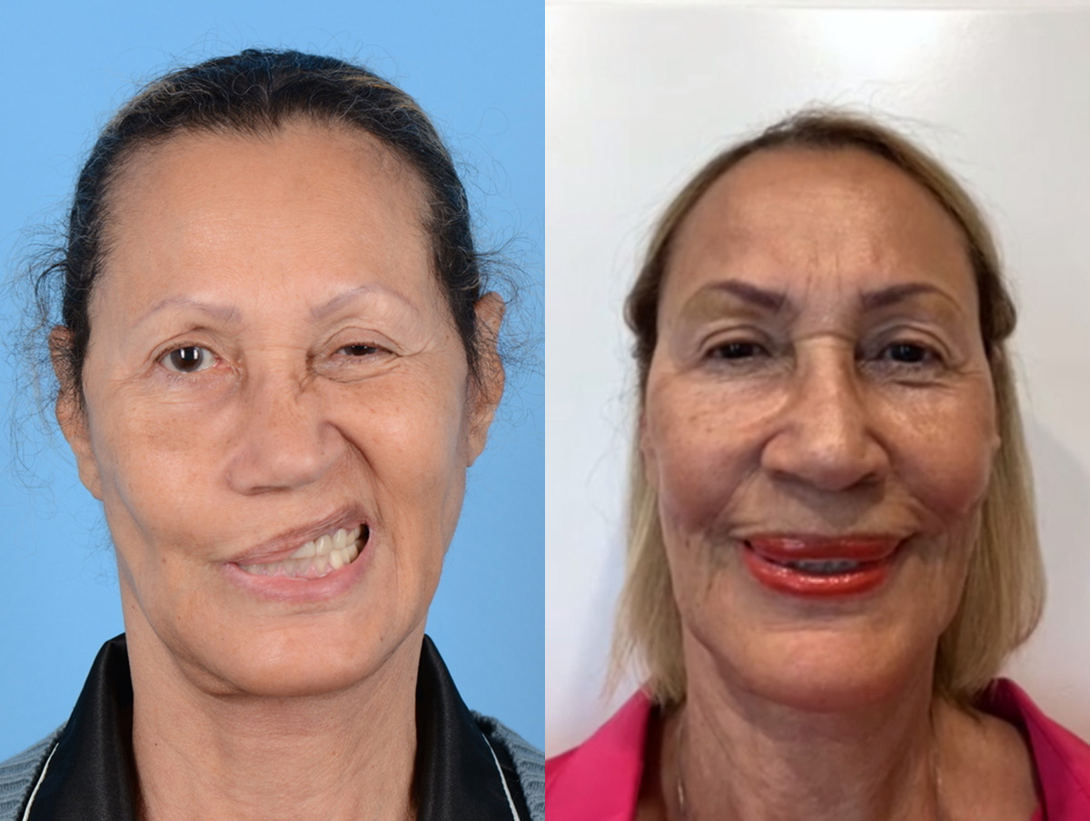 Facial Nerve Repair Before & After Gallery - Patient 287570 - Image 1