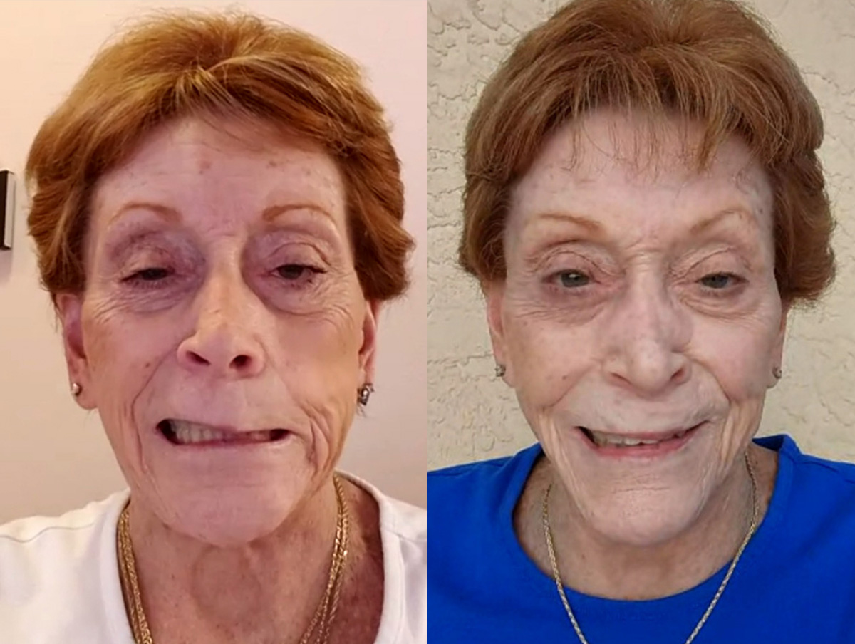 Facial Nerve Repair Before & After Gallery - Patient 769200 - Image 1