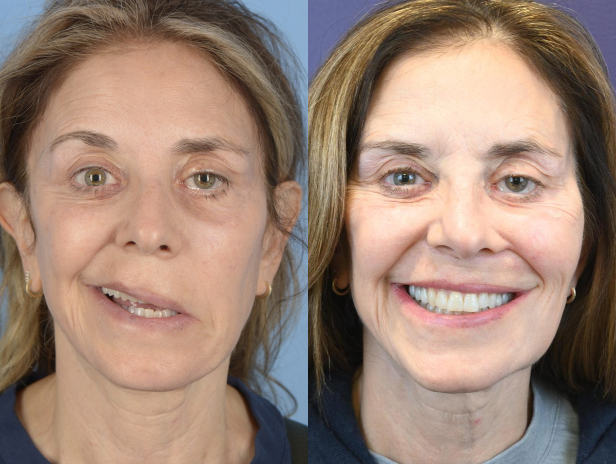Gracilis Before & After Gallery - Patient 407286 - Image 1