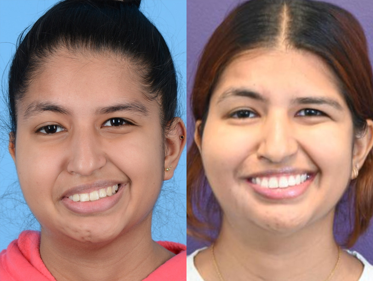 Gracilis Before & After Gallery - Patient 532607 - Image 1