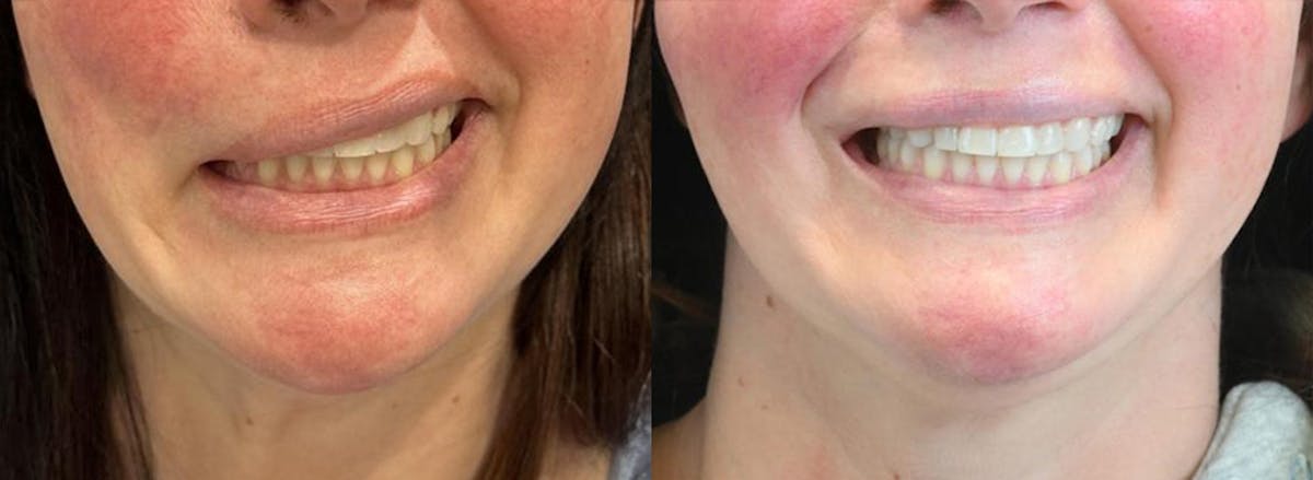Gracilis Before & After Gallery - Patient 329438 - Image 1