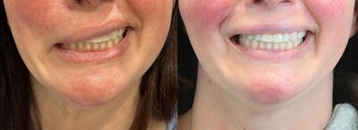 Gracilis Before & After Gallery - Patient 329438 - Image 1
