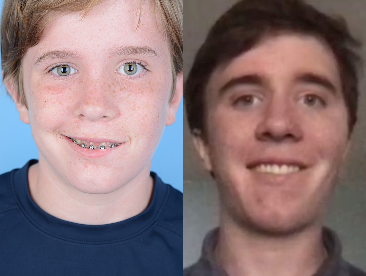 Gracilis Before & After Gallery - Patient 125711 - Image 1