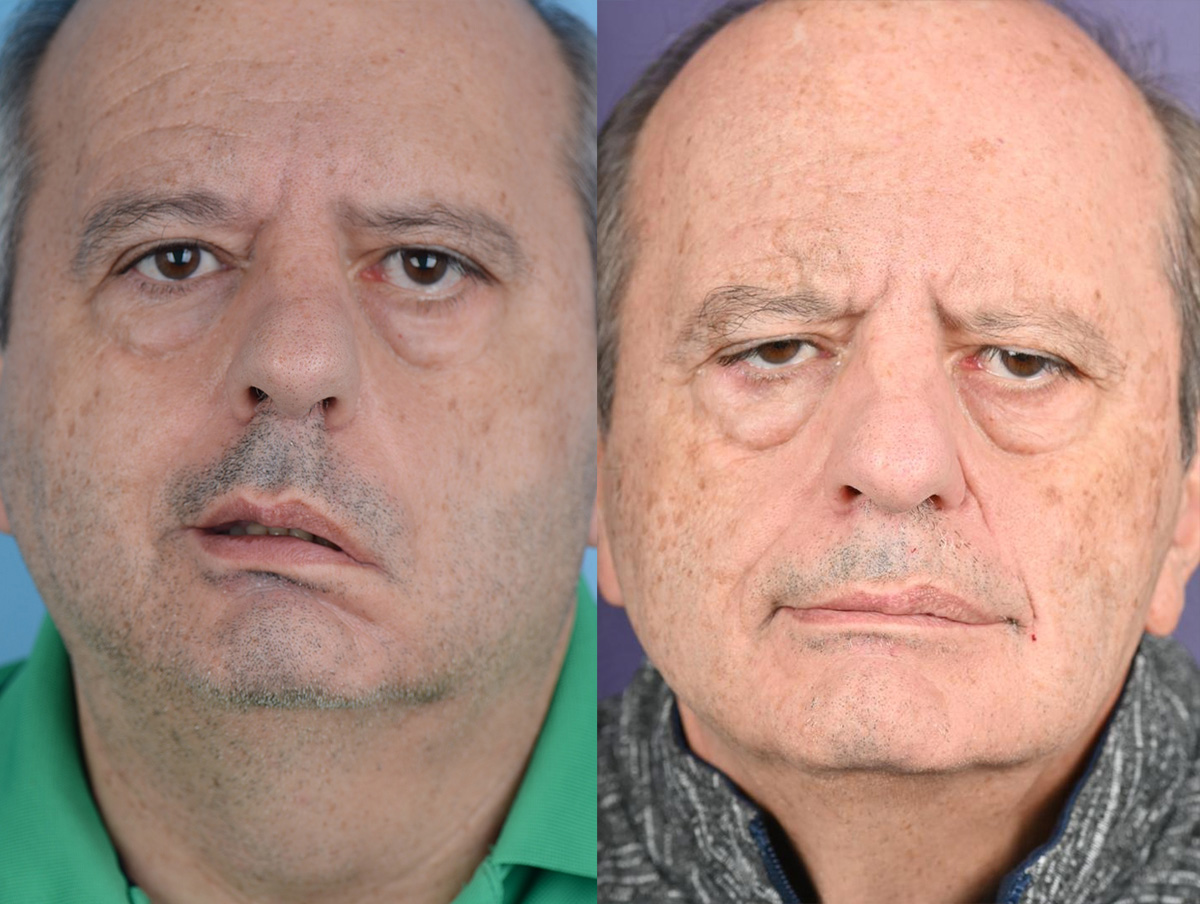 Static Suspension  Before & After Gallery - Patient 426510 - Image 1