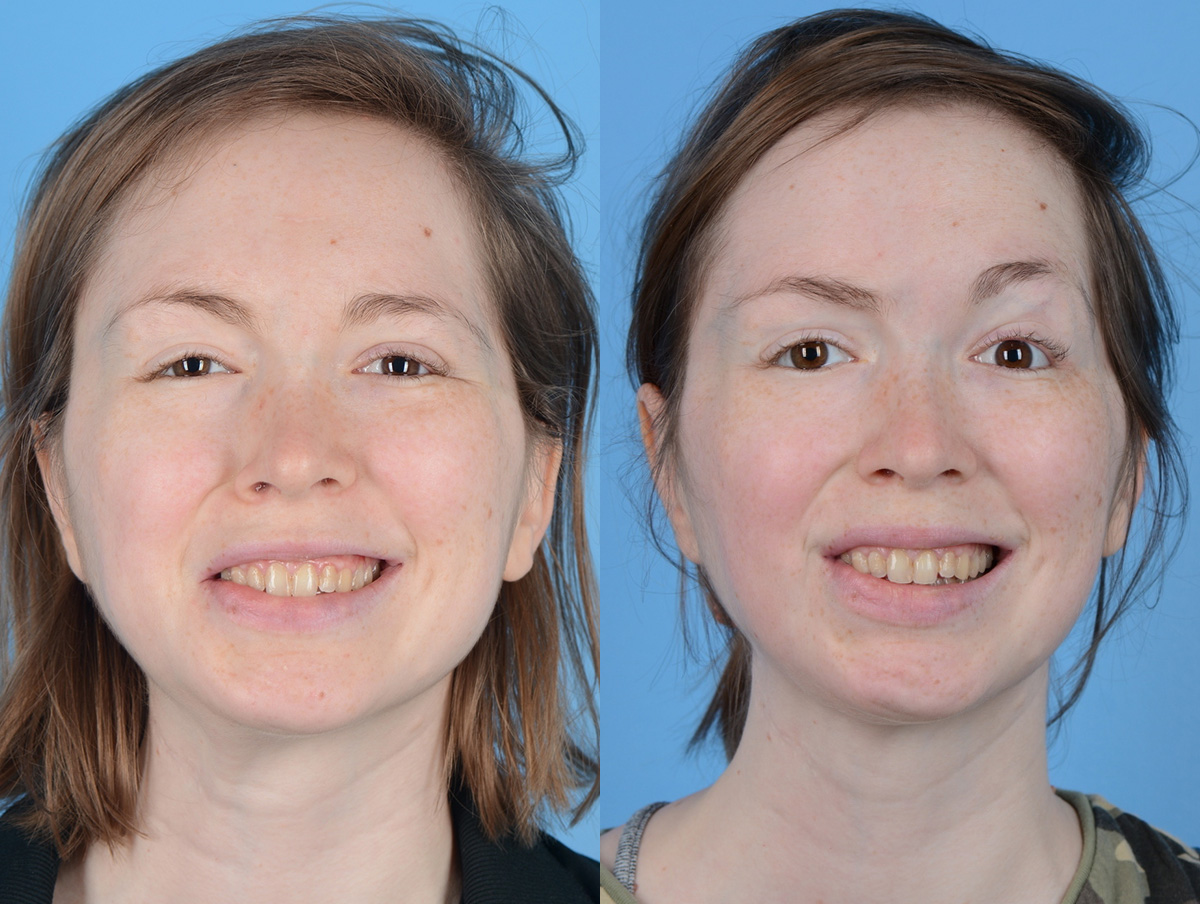 Muscle Resection: DAO, DLI, Ocular Myomectomy, Mentalis Before & After Gallery - Patient 138547 - Image 1
