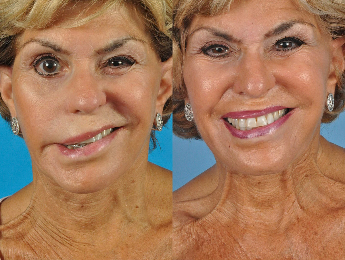 Facial Nerve Repair Before & After Gallery - Patient 277882 - Image 1