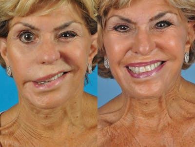 Facial Nerve Repair Before & After Gallery - Patient 277882 - Image 1