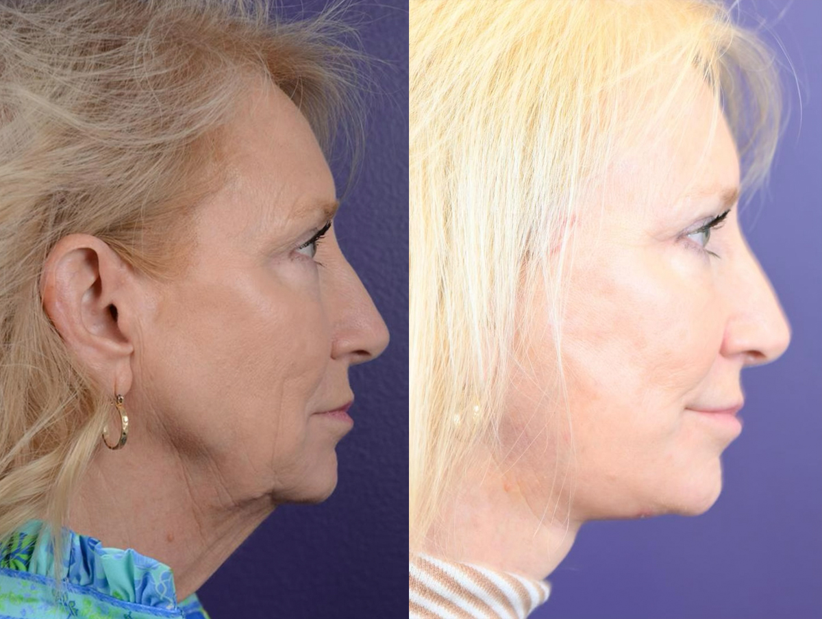 Office Facelift Before & After Gallery - Patient 722407 - Image 1
