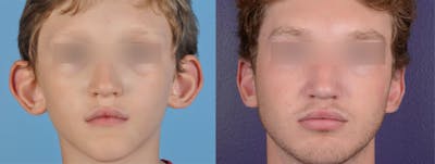 Otoplasty/Ear Pinning Before & After Gallery - Patient 287013 - Image 1