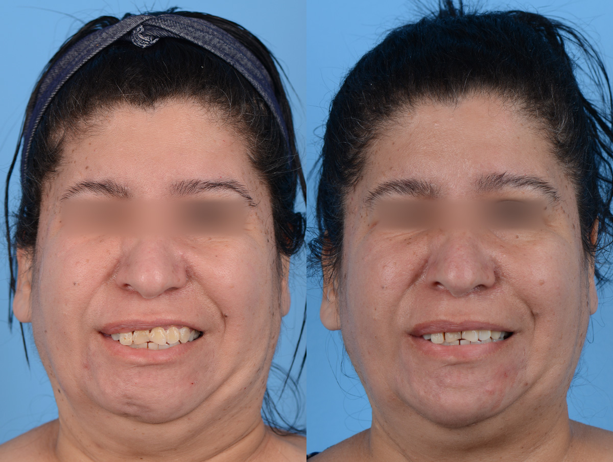 Muscle Resection: DAO, DLI, Ocular Myomectomy, Mentalis Before & After Gallery - Patient 256169 - Image 1