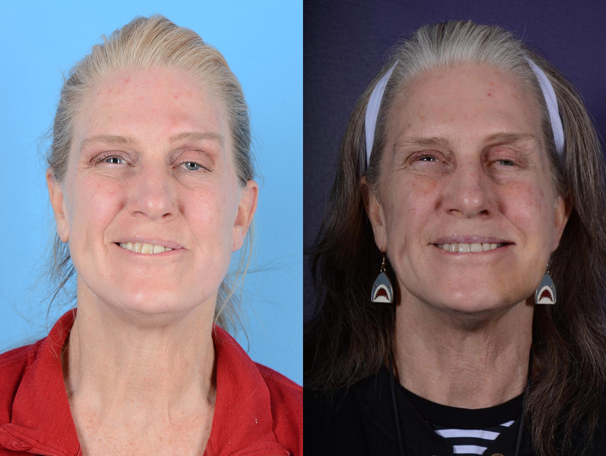 Gracilis Before & After Gallery - Patient 309584 - Image 1