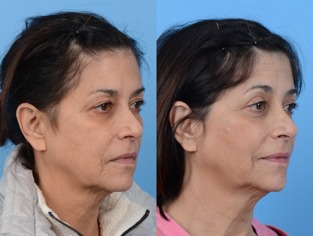 Blepharoplasty Before & After Gallery - Patient 164291 - Image 1