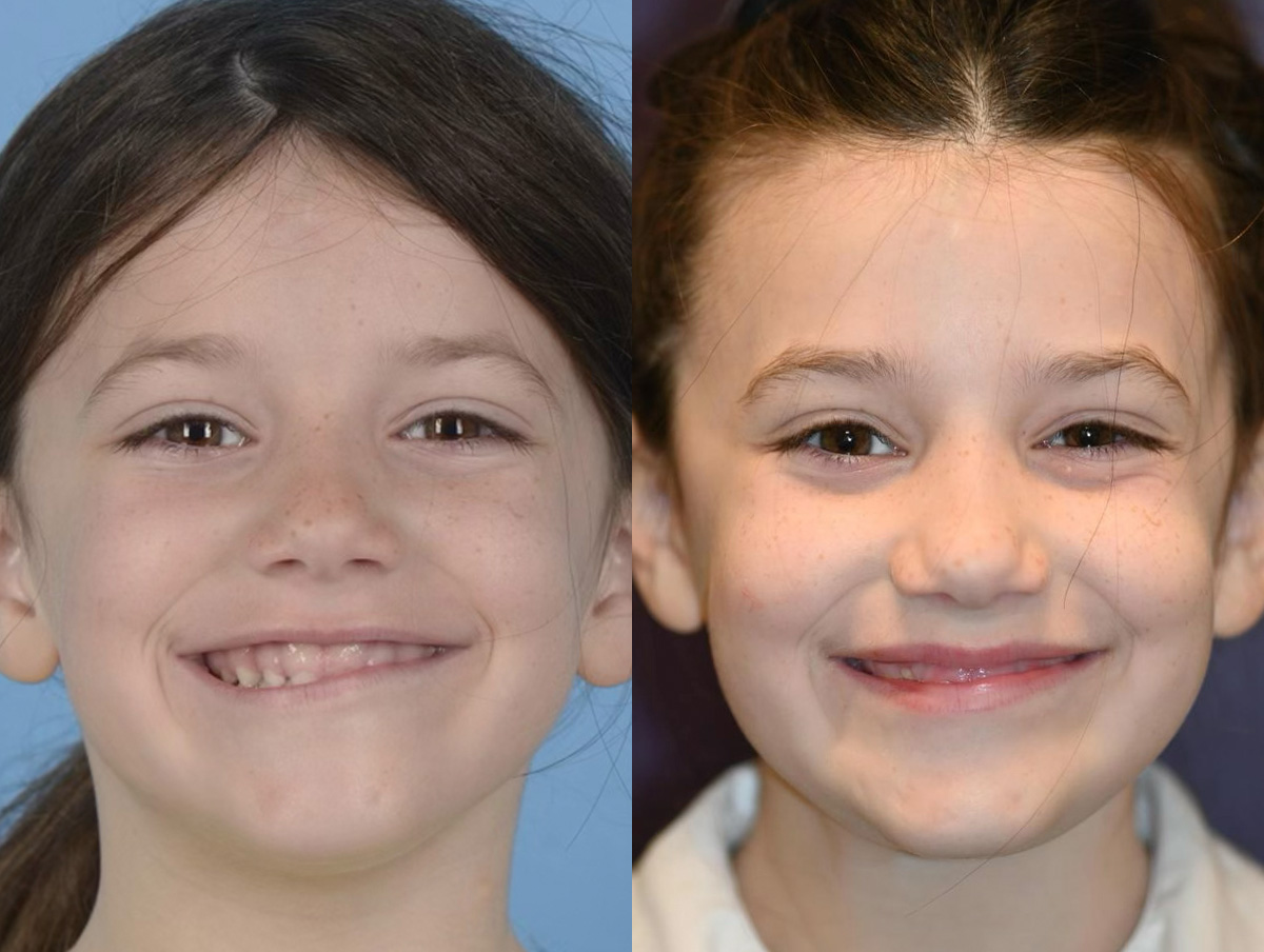 Muscle Resection: DAO, DLI, Ocular Myomectomy, Mentalis Before & After Gallery - Patient 158123 - Image 1