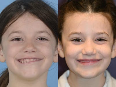 Muscle Resection: DAO, DLI, Ocular Myomectomy, Mentalis Before & After Gallery - Patient 158123 - Image 1