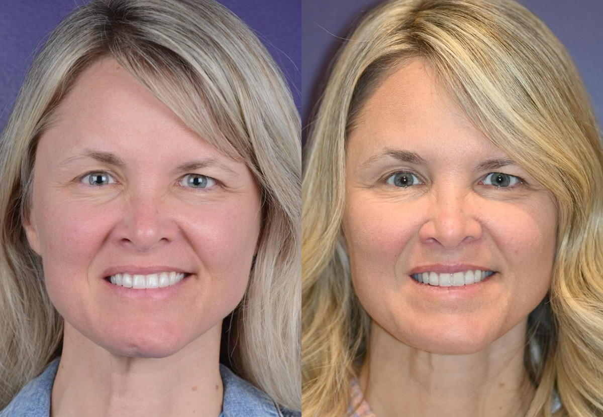 Muscle Resection: DAO, DLI, Ocular Myomectomy, Mentalis Before & After Gallery - Patient 209245 - Image 1