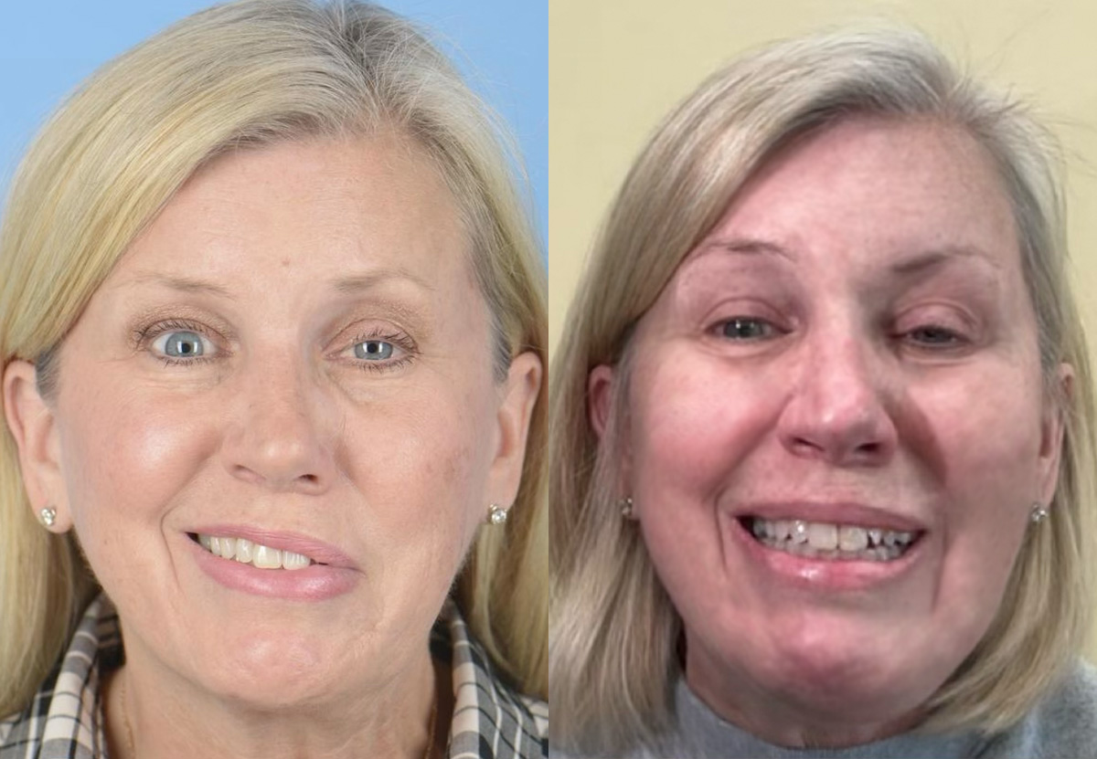 Denervation Before & After Gallery - Patient 389607 - Image 1