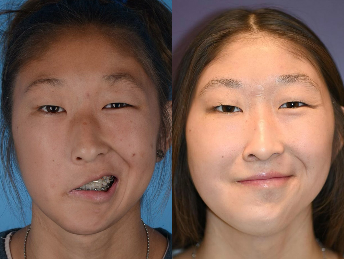 Gracilis Before & After Gallery - Patient 615243 - Image 1