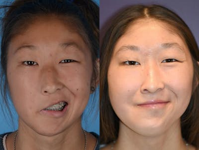 Gracilis Before & After Gallery - Patient 615243 - Image 1