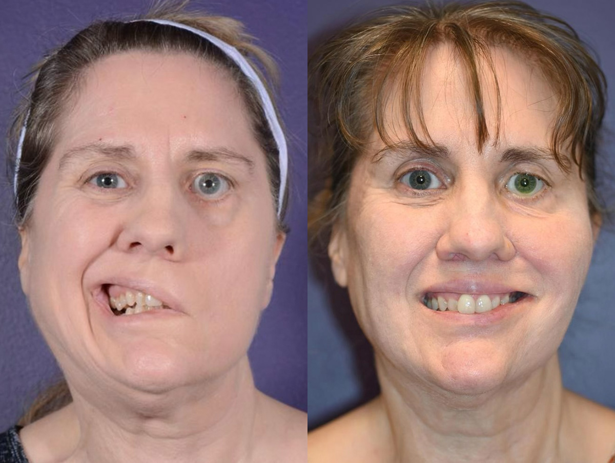 Gracilis Before & After Gallery - Patient 241343 - Image 1
