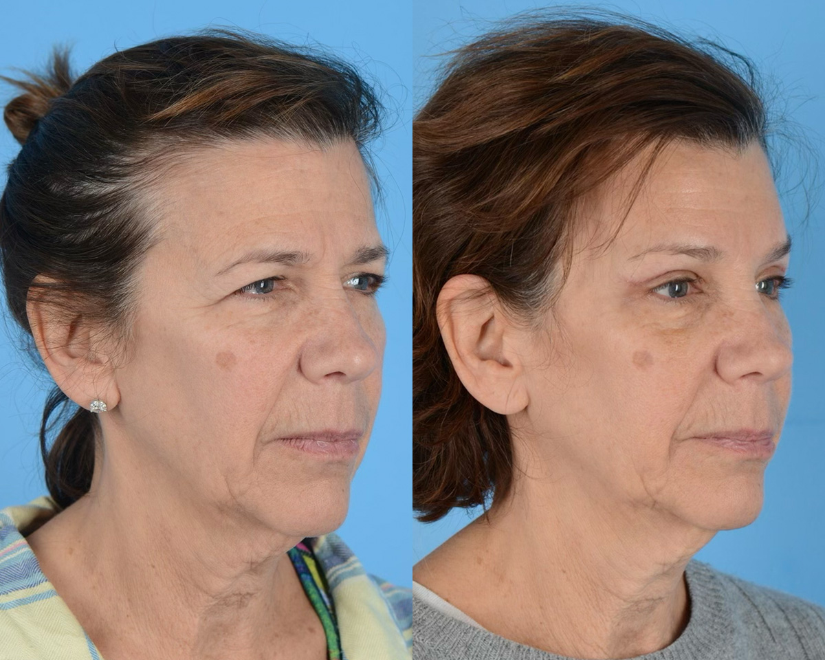 Blepharoplasty Before & After Gallery - Patient 193882 - Image 1