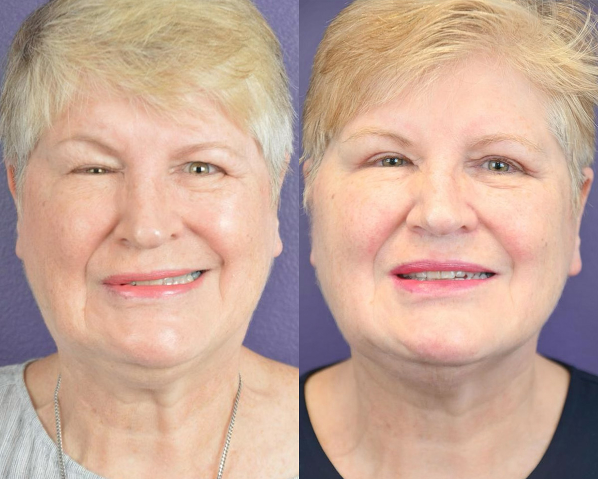 Denervation Before & After Gallery - Patient 418176 - Image 1