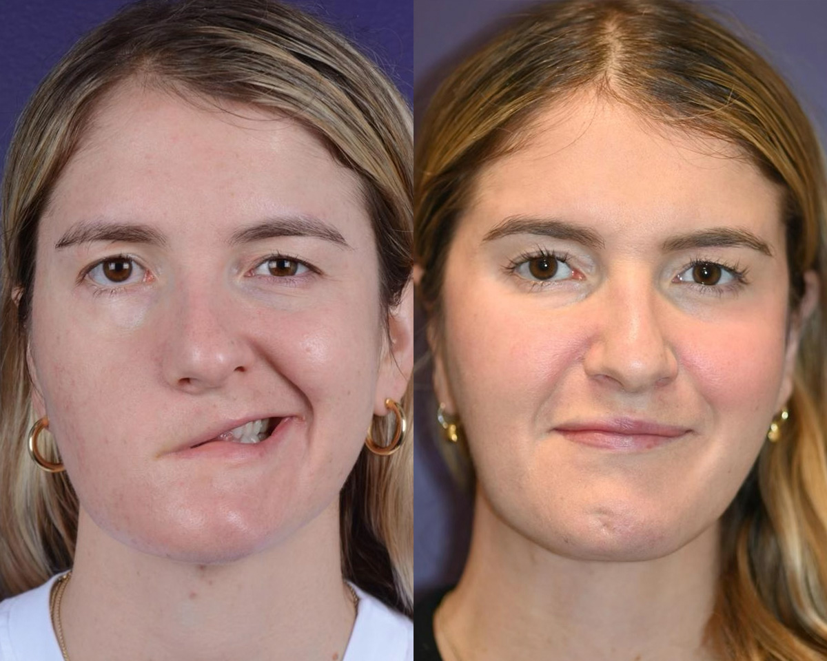 Reinnervation/Nerve Transfers Before & After Gallery - Patient 139941 - Image 1