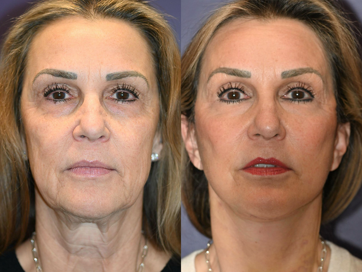 Office Facelift Before & After Gallery - Patient 235789 - Image 1