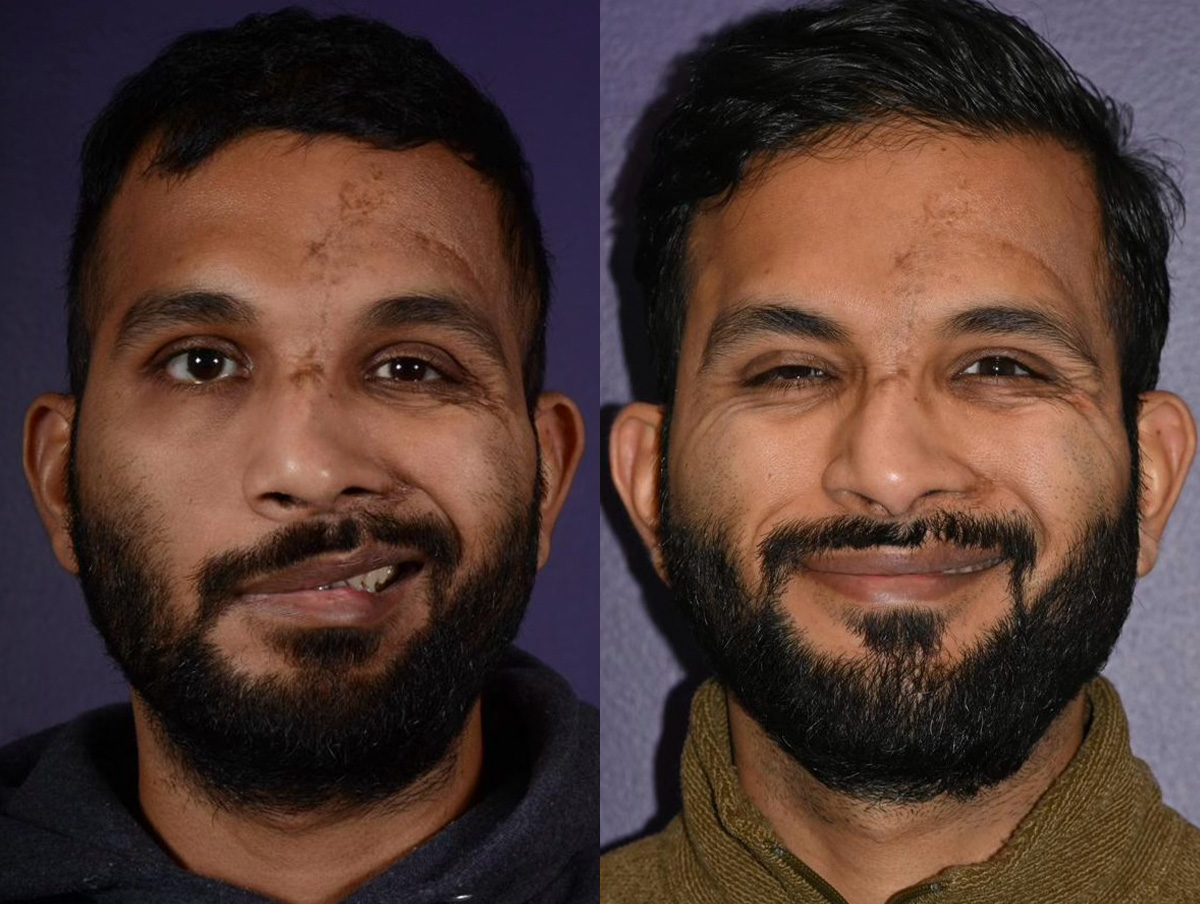 Reinnervation/Nerve Transfers Before & After Gallery - Patient 382622 - Image 1