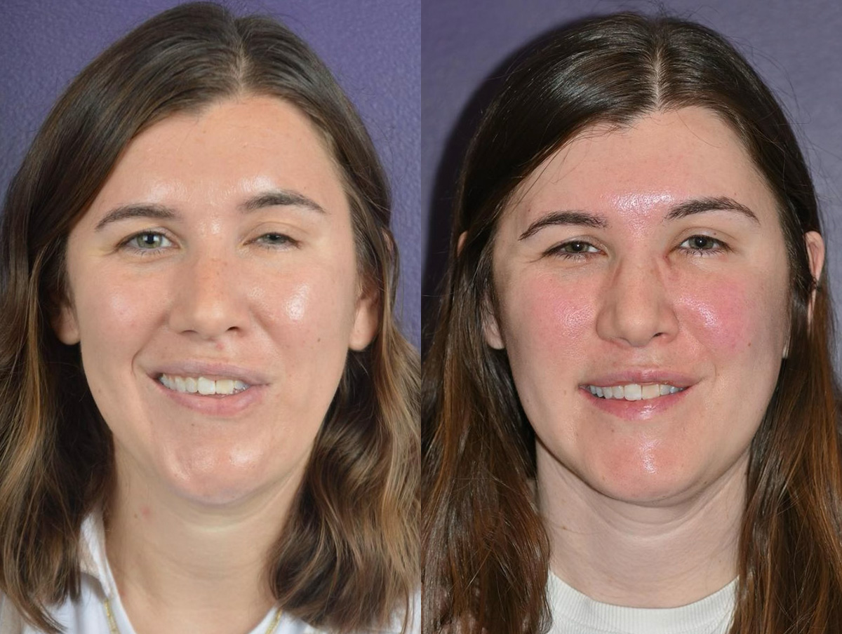 Muscle Resection: DAO, DLI, Ocular Myomectomy, Mentalis Before & After Gallery - Patient 368990 - Image 1