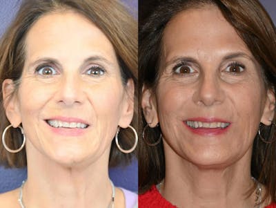 Muscle Resection: DAO, DLI, Ocular Myomectomy, Mentalis Before & After Gallery - Patient 359972 - Image 1