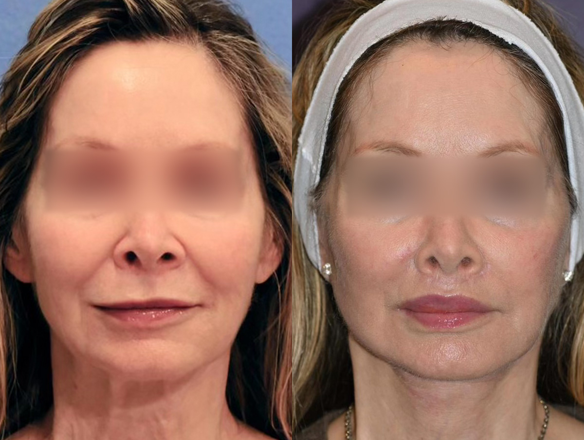 Lip Lift Before & After Gallery - Patient 299032 - Image 1