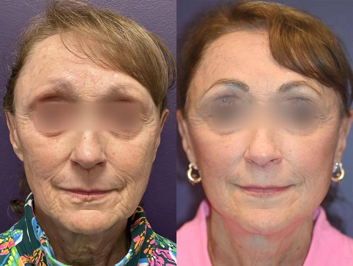 Office Facelift Before & After Gallery - Patient 272482 - Image 1