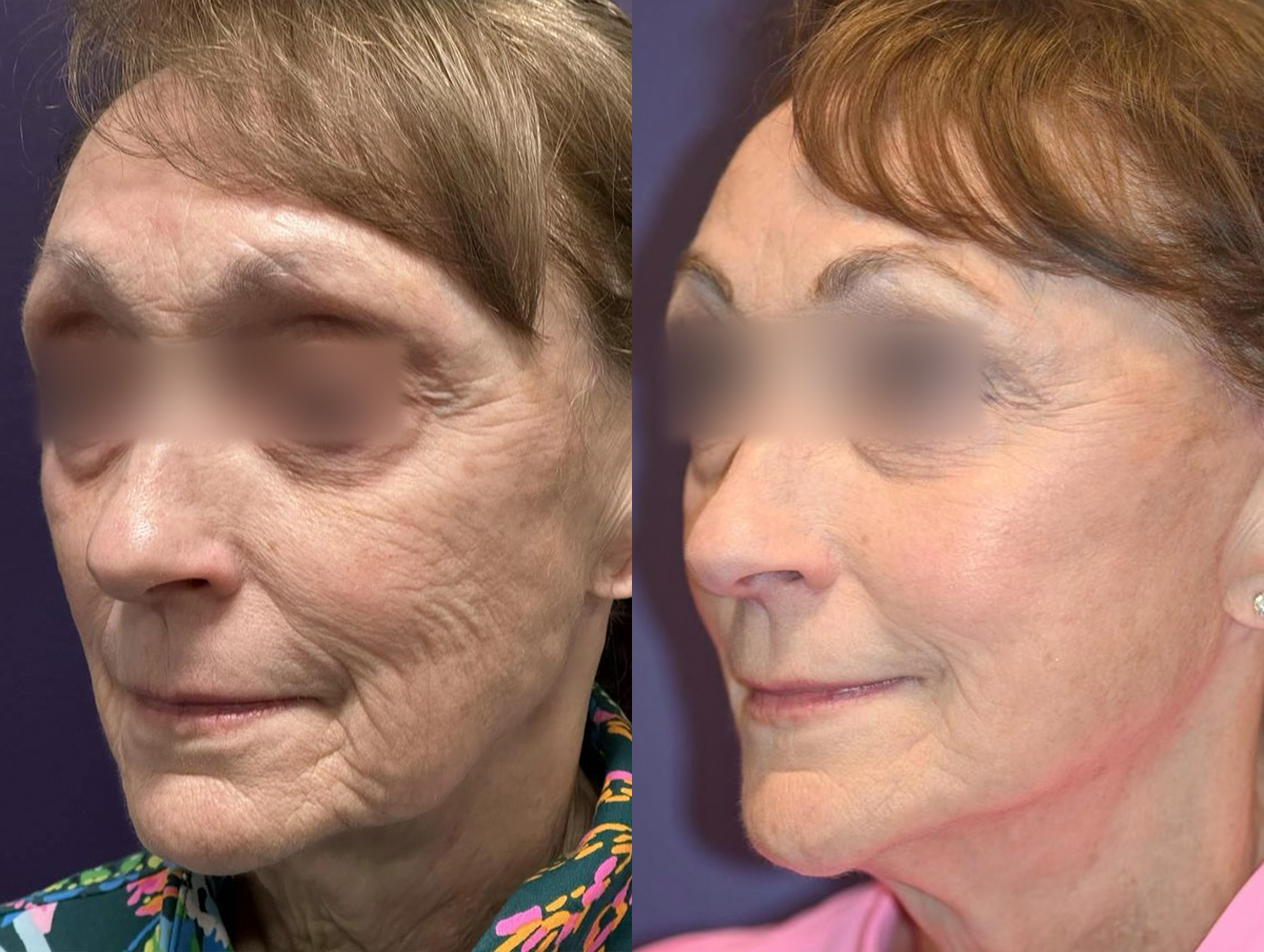 Office Facelift Before & After Gallery - Patient 272482 - Image 2