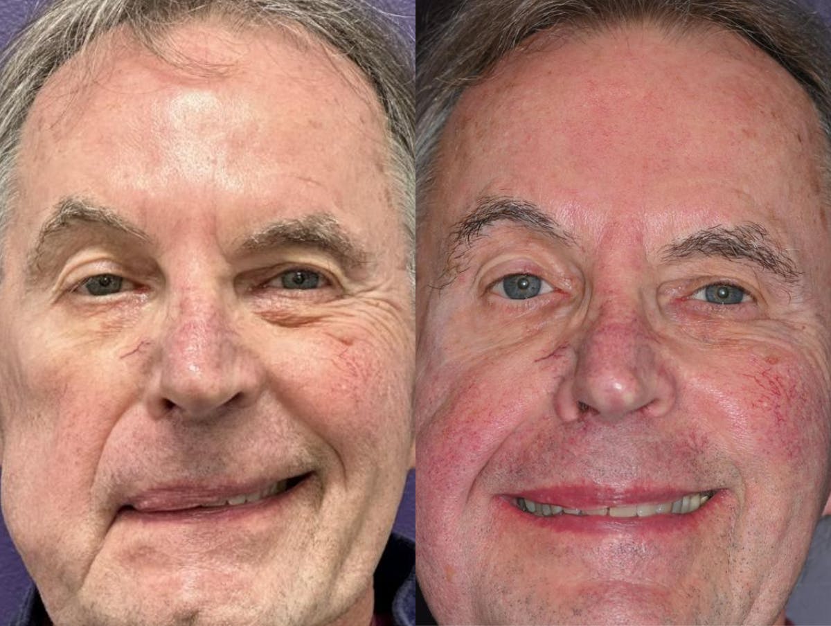 Gracilis Before & After Gallery - Patient 388113 - Image 1