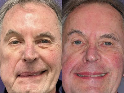 Gracilis Before & After Gallery - Patient 388113 - Image 1