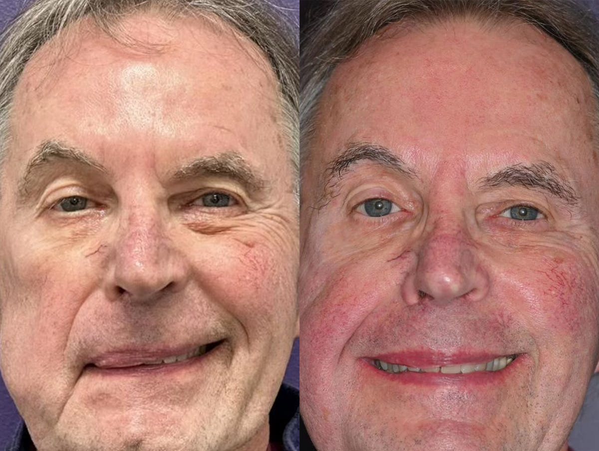 Gracilis Before & After Gallery - Patient 367105 - Image 1