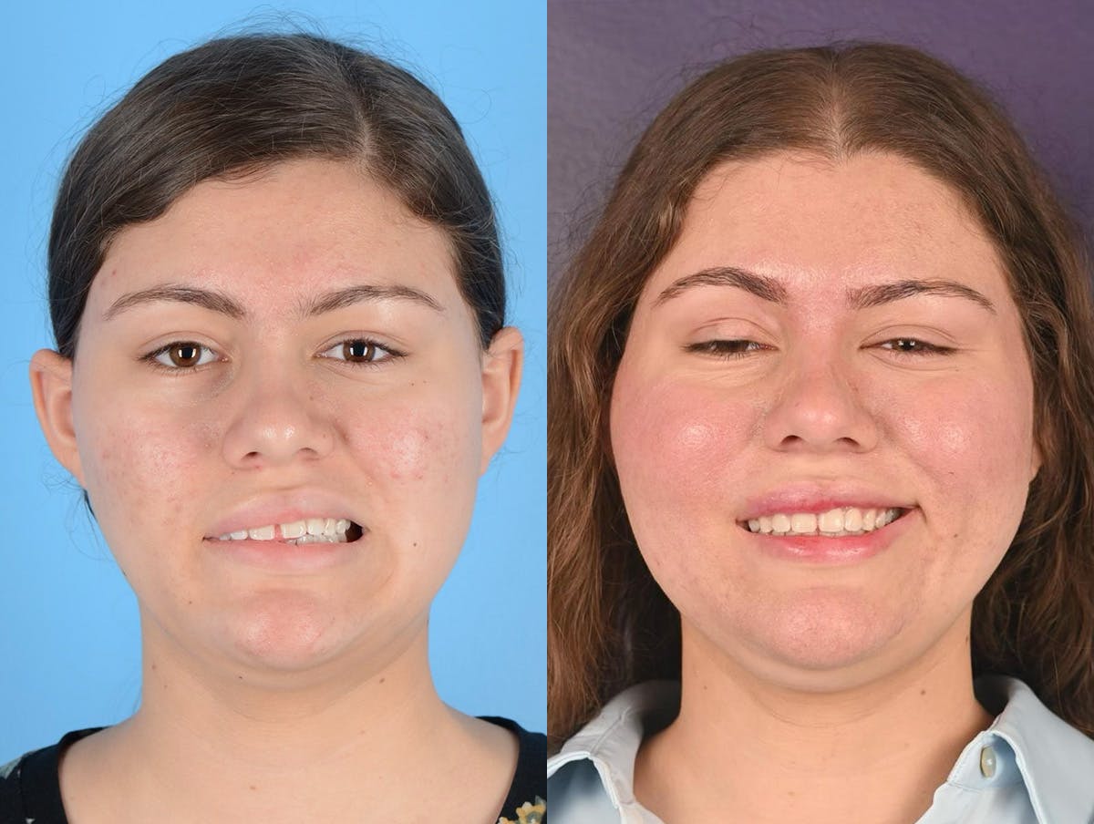 Gracilis Before & After Gallery - Patient 294278 - Image 1